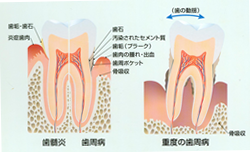 歯周病