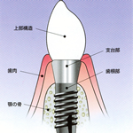 インプラント治療