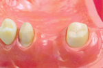 代表的な義歯