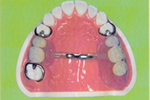 代表的な義歯