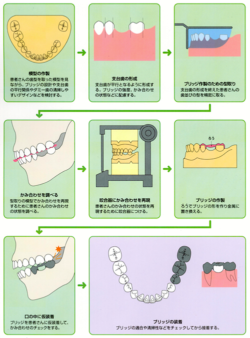 代表的な義歯