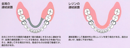 代表的な義歯