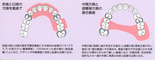 代表的な義歯